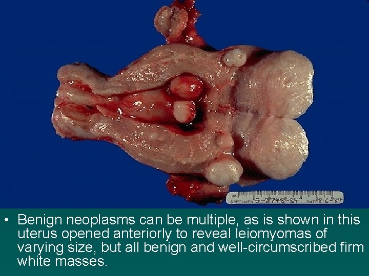  • Benign neoplasms can be multiple, as is shown in this uterus opened