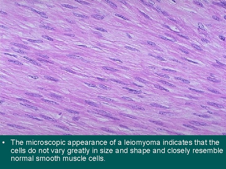  • The microscopic appearance of a leiomyoma indicates that the cells do not