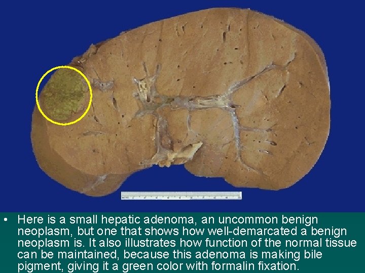  • Here is a small hepatic adenoma, an uncommon benign neoplasm, but one