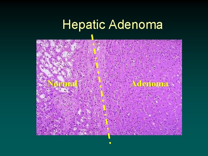 Hepatic Adenoma Normal Adenoma 