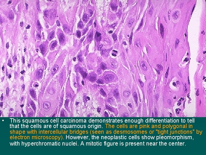  • This squamous cell carcinoma demonstrates enough differentiation to tell that the cells