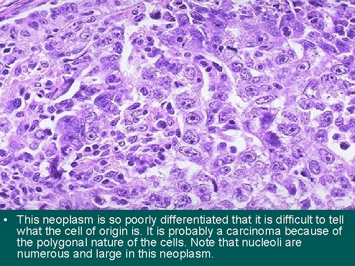  • This neoplasm is so poorly differentiated that it is difficult to tell