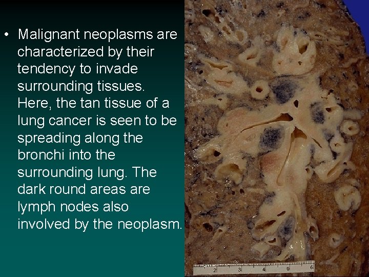  • Malignant neoplasms are characterized by their tendency to invade surrounding tissues. Here,