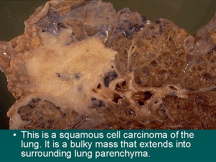  • This is a squamous cell carcinoma of the lung. It is a