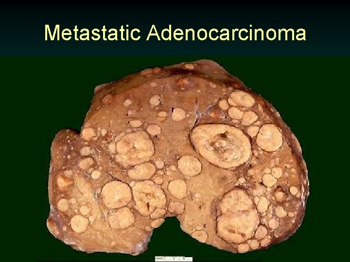 Metastatic Adenocarcinoma 