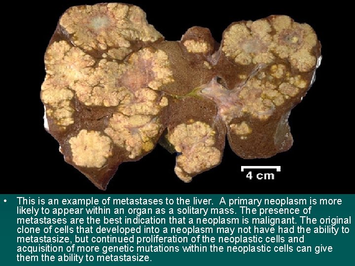  • This is an example of metastases to the liver. A primary neoplasm