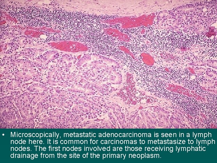  • Microscopically, metastatic adenocarcinoma is seen in a lymph node here. It is