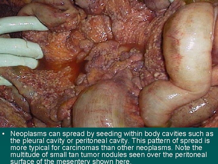  • Neoplasms can spread by seeding within body cavities such as the pleural