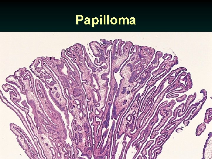 Papilloma 