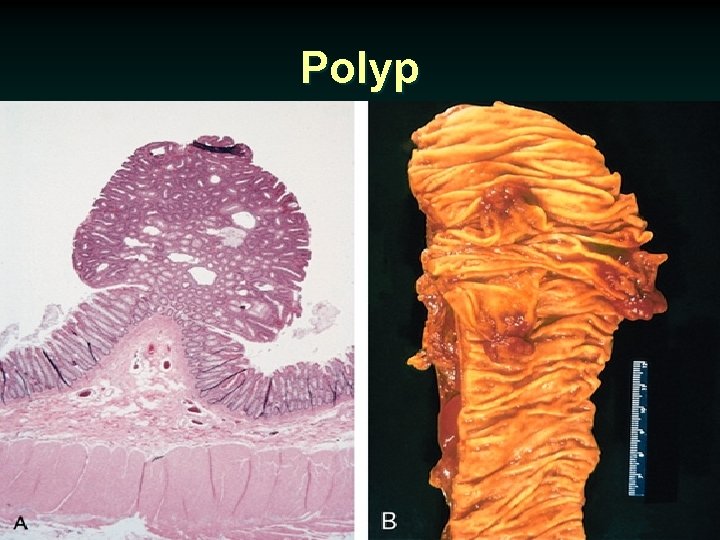 Polyp 