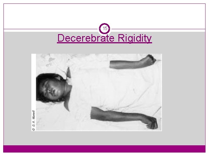 15 Decerebrate Rigidity 