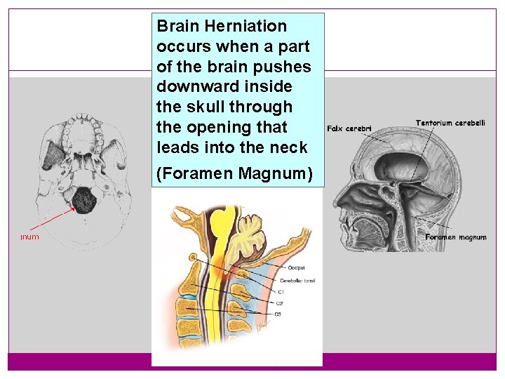 Brain Herniation occurs when a part of the brain 16 pushes downward inside the