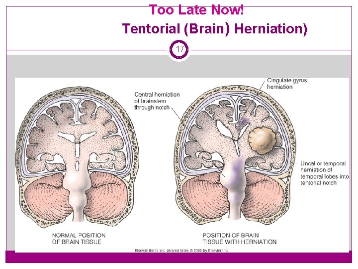 Too Late Now! Tentorial (Brain) Herniation) 17 