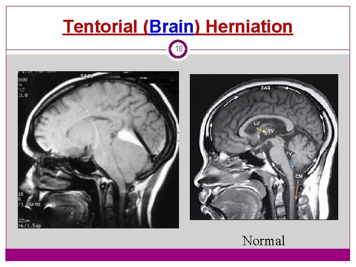 Tentorial (Brain) Herniation 18 Normal 