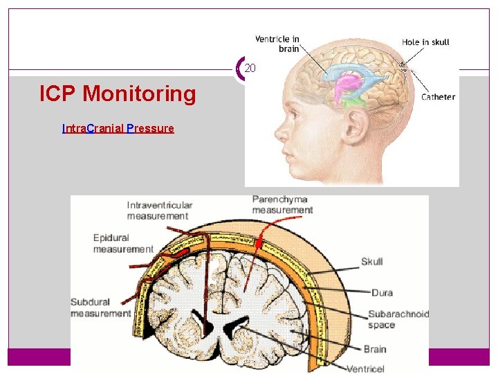 20 ICP Monitoring Intra. Cranial Pressure 