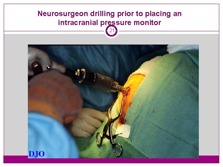 Neurosurgeon drilling prior to placing an intracranial pressure monitor 21 