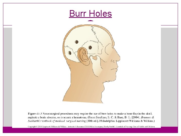 Burr Holes 29 