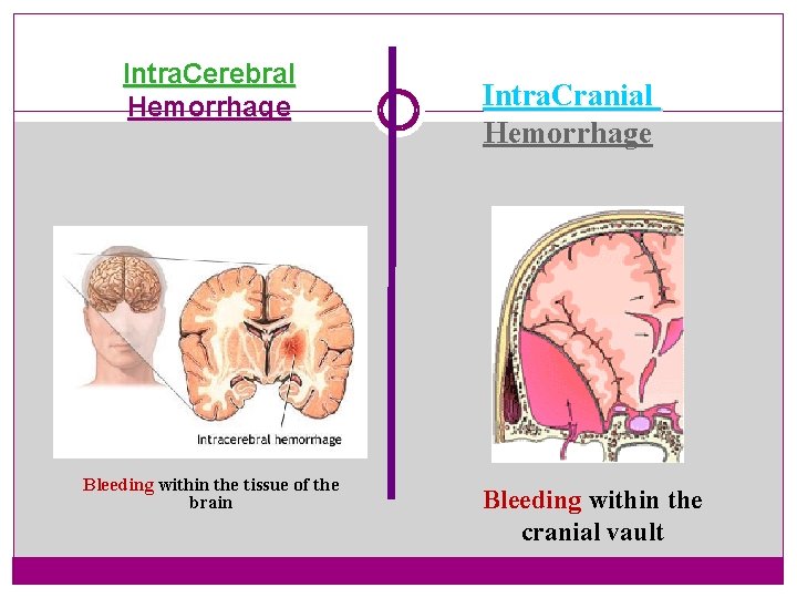 Intra. Cerebral Hemorrhage Bleeding within the tissue of the brain Intra. Cranial Hemorrhage Bleeding