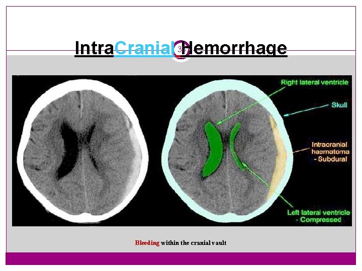 Intra. Cranial 38 Hemorrhage Bleeding within the cranial vault 