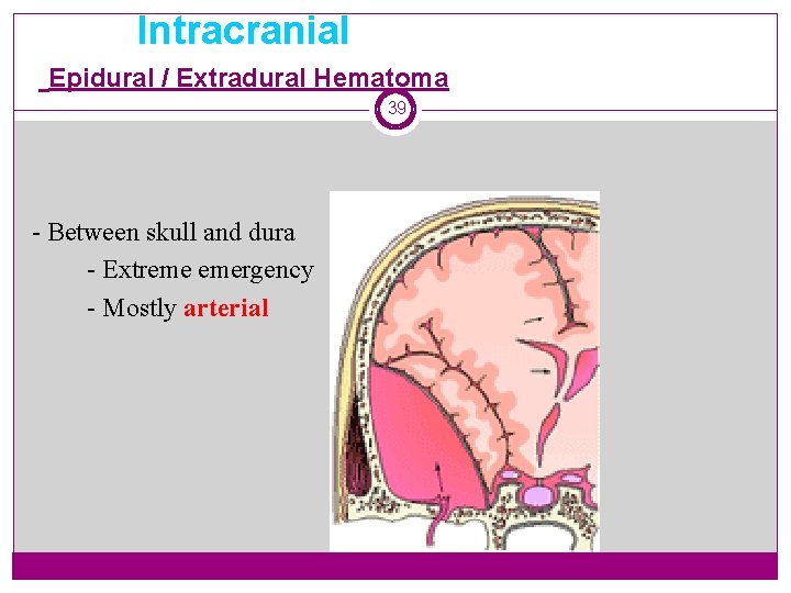 Intracranial Epidural / Extradural Hematoma 39 - Between skull and dura - Extreme emergency