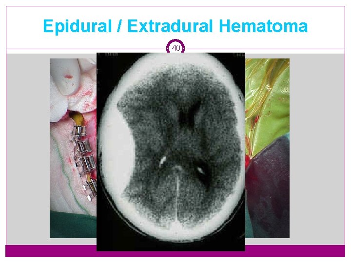 Epidural / Extradural Hematoma 40 
