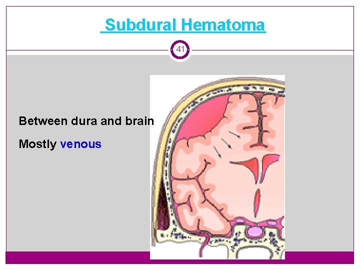 Subdural Hematoma 41 Between dura and brain Mostly venous 