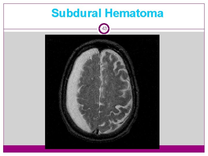 Subdural Hematoma 43 