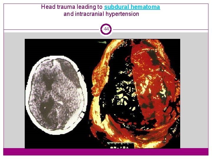 Head trauma leading to subdural hematoma and intracranial hypertension 44 