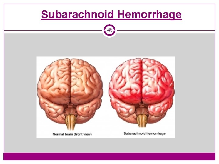 Subarachnoid Hemorrhage 46 