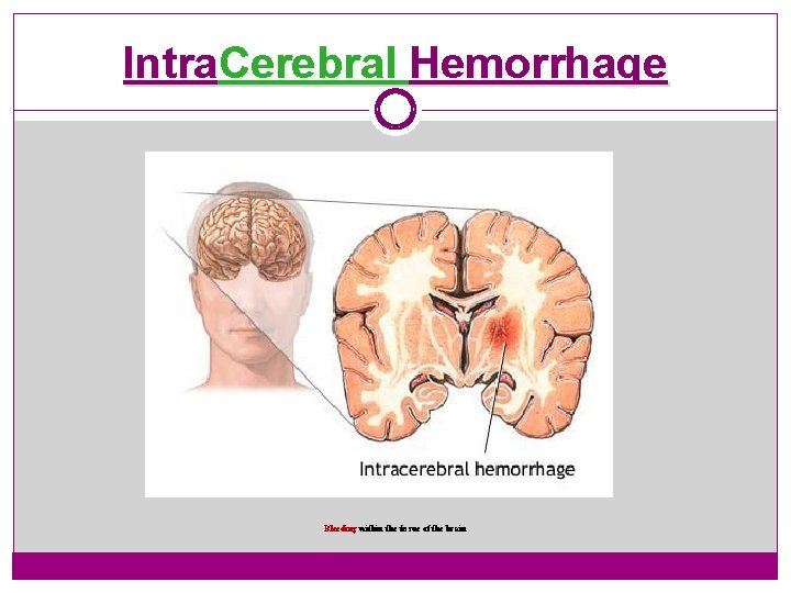 Intra. Cerebral Hemorrhage Bleeding within the tissue of the brain 