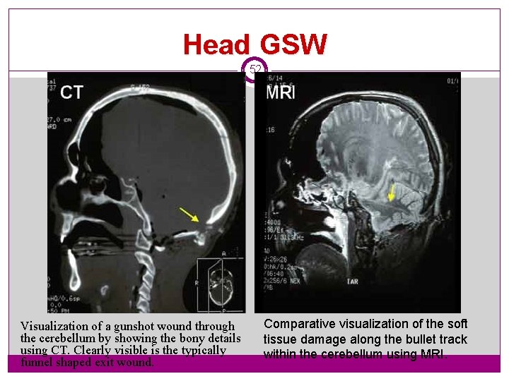 Head GSW 52 Visualization of a gunshot wound through the cerebellum by showing the