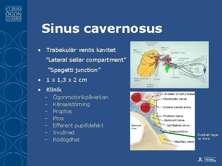 Sinus cavernosus • Trabekulär venös kavitet ”Lateral sellar compartment” ”Spagetti junction” • 1 x