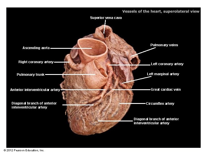 Superior vena cava Ascending aorta Right coronary artery Pulmonary trunk Anterior interventricular artery Diagonal