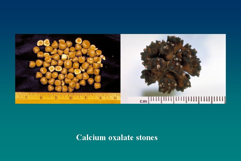 Calcium oxalate stones 