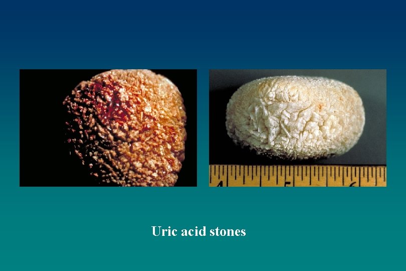 Uric acid stones 