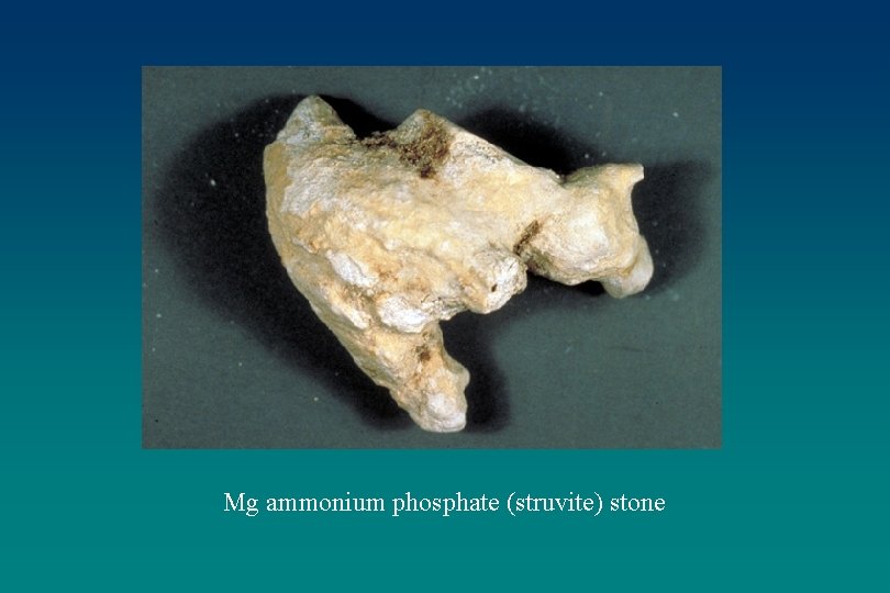 Mg ammonium phosphate (struvite) stone 
