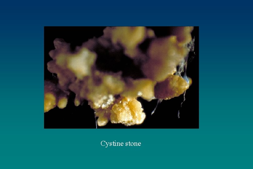Cystine stone 