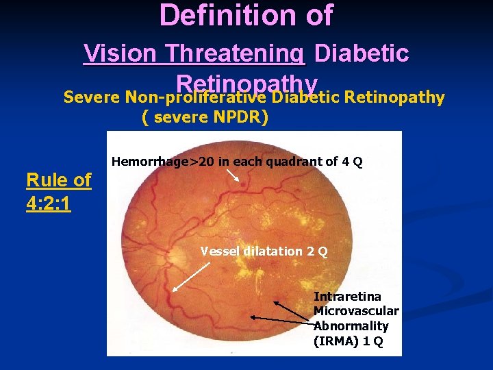 Definition of Vision Threatening Diabetic Retinopathy Severe Non-proliferative Diabetic Retinopathy ( severe NPDR) Hemorrhage>20