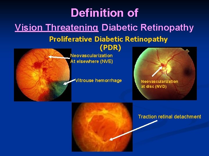 Definition of Vision Threatening Diabetic Retinopathy Proliferative Diabetic Retinopathy (PDR) Neovascularization At elsewhere (NVE)