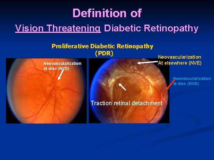 Definition of Vision Threatening Diabetic Retinopathy Proliferative Diabetic Retinopathy (PDR) Neovascularization at disc (NVD)