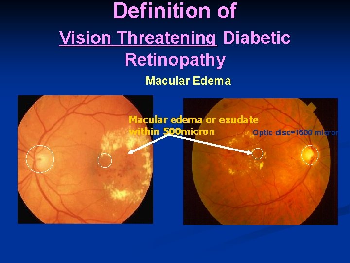 Definition of Vision Threatening Diabetic Retinopathy Macular Edema Macular edema or exudate within 500