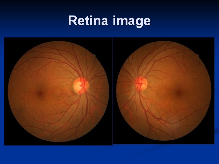Retina image 