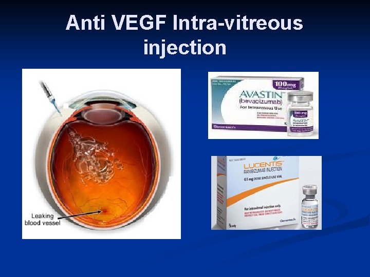 Anti VEGF Intra-vitreous injection 