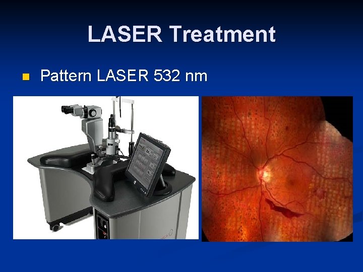 LASER Treatment n Pattern LASER 532 nm 