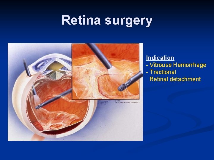 Retina surgery Indication - Vitrouse Hemorrhage - Tractional Retinal detachment 