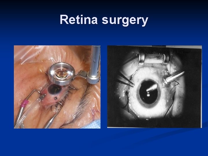 Retina surgery 
