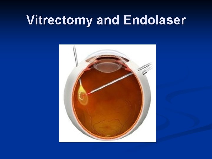 Vitrectomy and Endolaser 