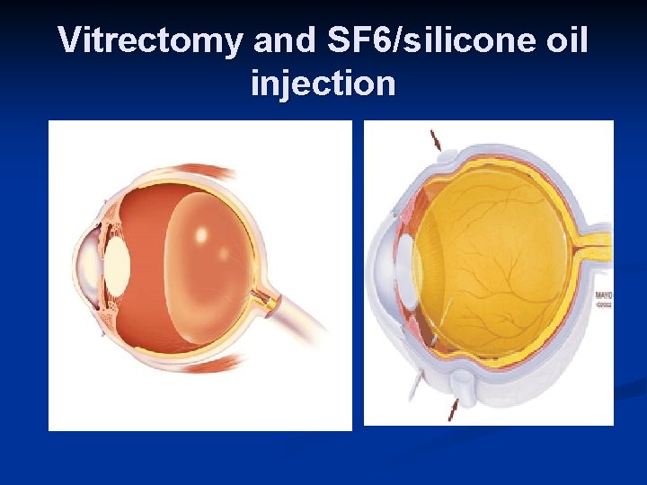Vitrectomy and SF 6/silicone oil injection 