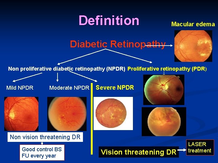 Definition Macular edema Diabetic Retinopathy Non proliferative diabetic retinopathy (NPDR) Proliferative retinopathy (PDR) Mild