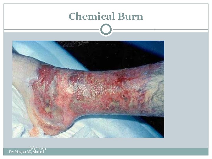 Chemical Burn 3/1/2021 Dr: Nagwa M. , Ahmed 